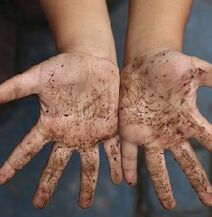 dirty hands as a cause of worms in children