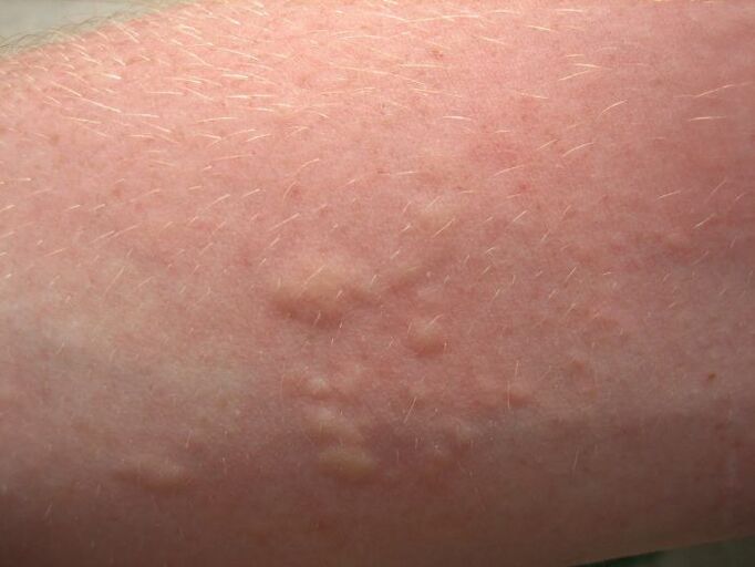 itchy allergic skin rash can be a symptom of ascariasis