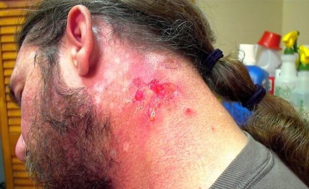 Bleeding wounds on the neck with Morgellons virus