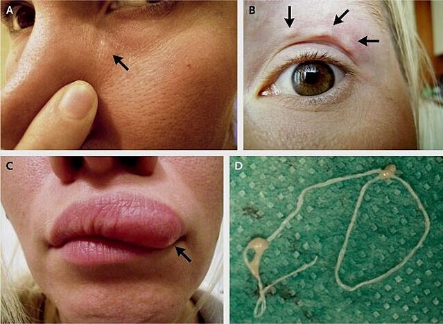 The main manifestation of dirofilariasis on the face