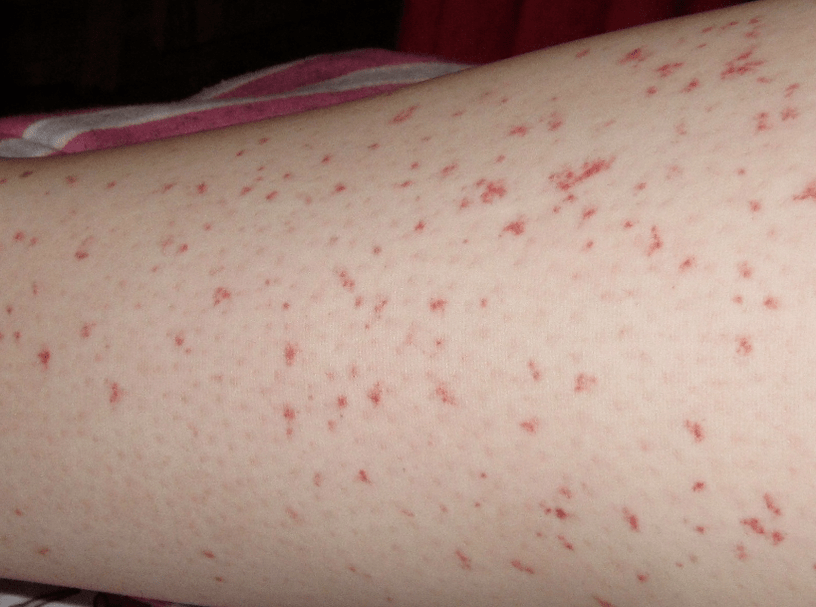 A skin rash is a sign of the acute stage of a worm infection