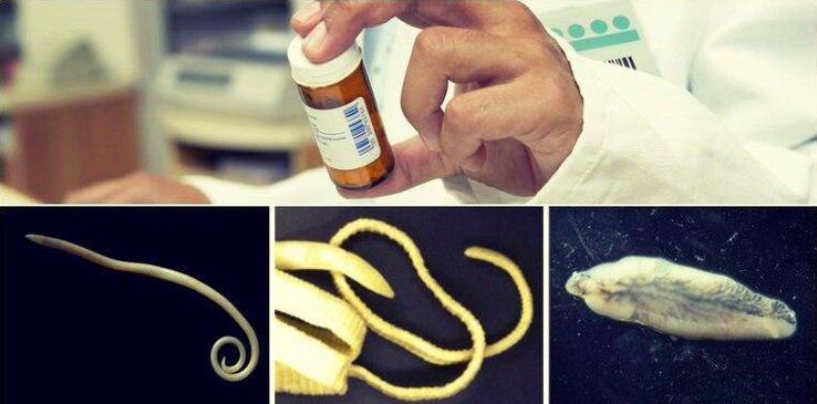Types of worms and medical methods to get rid of them